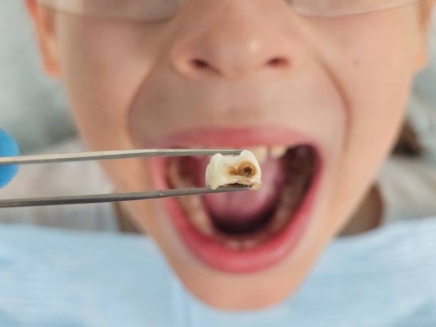 Best Emergency Dental Care for Abscessed Tooth in Madison, NJ